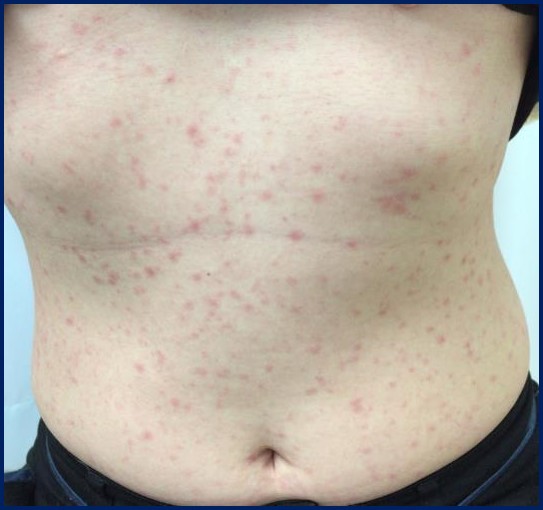 感染から約３か月後、全身に痛くもかゆくもないピンク色の発しんが出ている様子（バラ疹）の写真