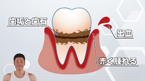歯周病予防動画